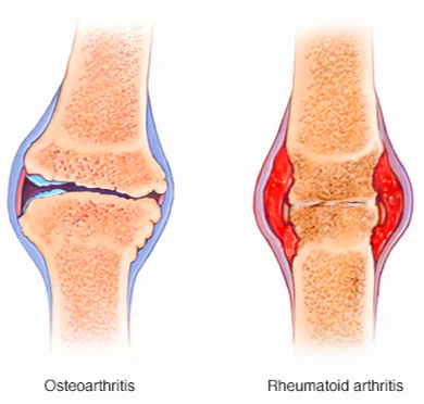 Glomerulonephritis