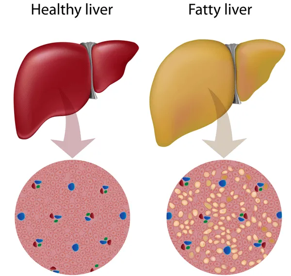 Fatty Liver Disease