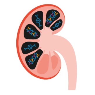 IGA-Nephropathy