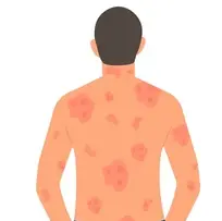 Psoriasis